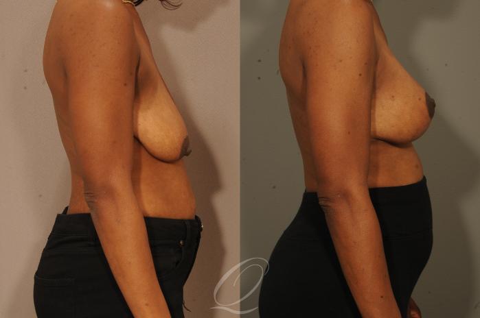 Breast Augmentation with Lift Case 301 Before & After View #3 | Serving Rochester, Syracuse & Buffalo, NY | Quatela Center for Plastic Surgery