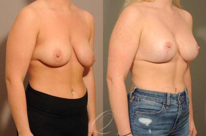 Breast Augmentation with Lift Case 304 Before & After View #2 | Serving Rochester, Syracuse & Buffalo, NY | Quatela Center for Plastic Surgery