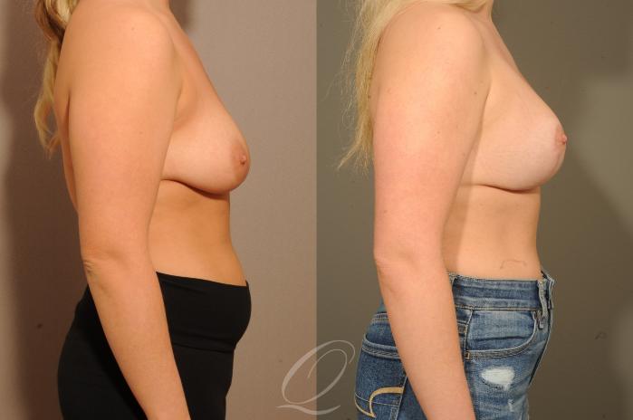 Breast Augmentation with Lift Case 304 Before & After View #3 | Serving Rochester, Syracuse & Buffalo, NY | Quatela Center for Plastic Surgery