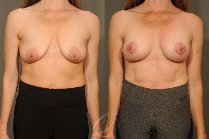 Breast Augmentation with Lift Case 320 Before & After View #1 | Serving Rochester, Syracuse & Buffalo, NY | Quatela Center for Plastic Surgery