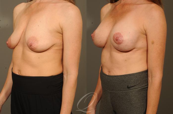 Breast Augmentation with Lift Case 320 Before & After View #2 | Serving Rochester, Syracuse & Buffalo, NY | Quatela Center for Plastic Surgery