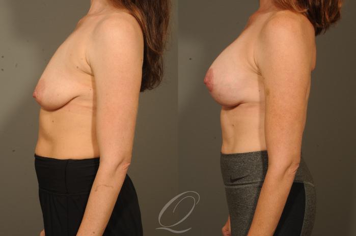 Breast Augmentation with Lift Case 320 Before & After View #3 | Serving Rochester, Syracuse & Buffalo, NY | Quatela Center for Plastic Surgery