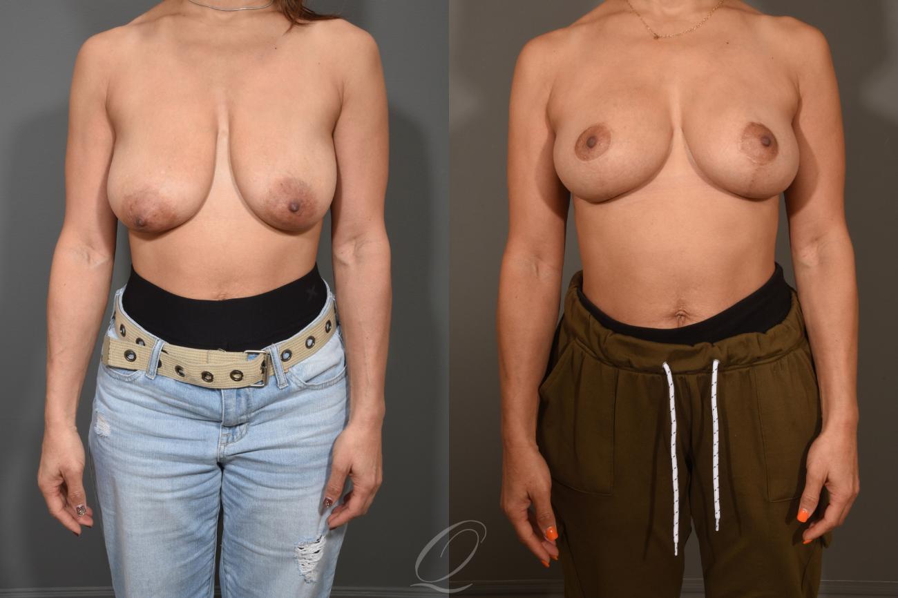Breast Lift Case 1001312 Before & After View #1 | Serving Rochester, Syracuse & Buffalo, NY | Quatela Center for Plastic Surgery