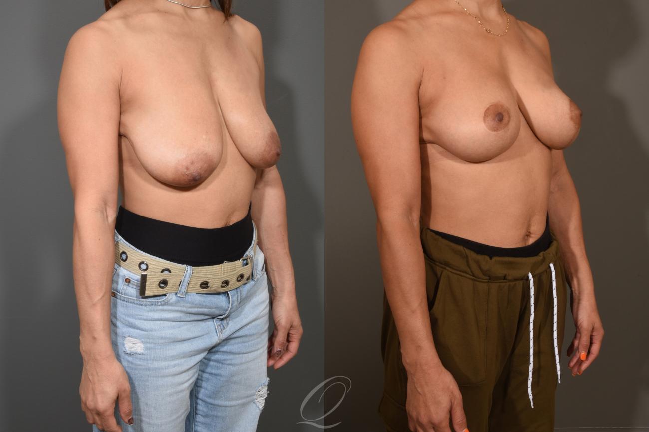 Breast Lift Case 1001312 Before & After View #2 | Serving Rochester, Syracuse & Buffalo, NY | Quatela Center for Plastic Surgery