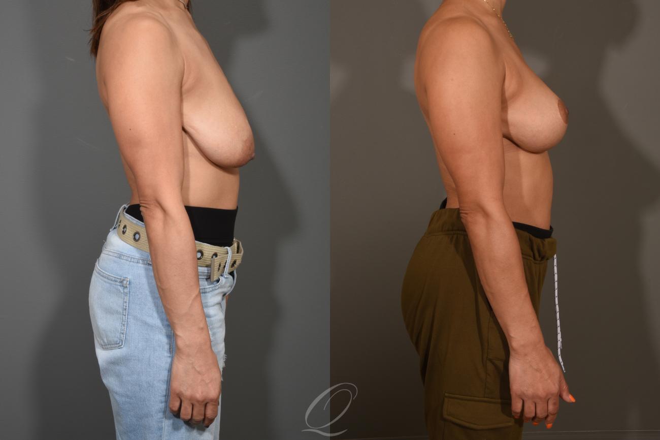 Breast Lift Case 1001312 Before & After View #3 | Serving Rochester, Syracuse & Buffalo, NY | Quatela Center for Plastic Surgery