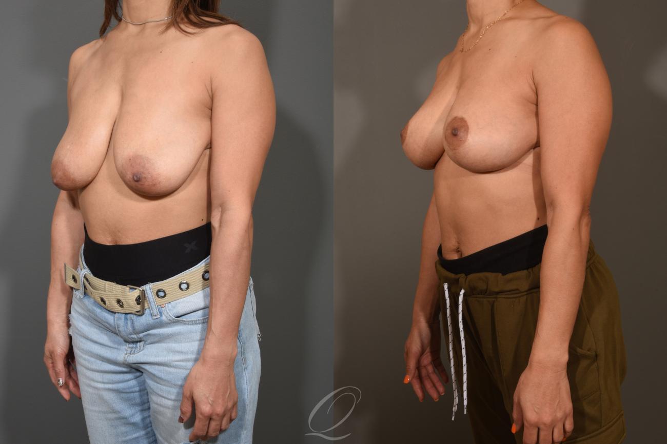 Breast Lift Case 1001312 Before & After View #4 | Serving Rochester, Syracuse & Buffalo, NY | Quatela Center for Plastic Surgery