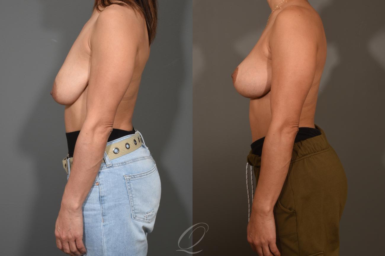 Breast Lift Case 1001312 Before & After View #5 | Serving Rochester, Syracuse & Buffalo, NY | Quatela Center for Plastic Surgery