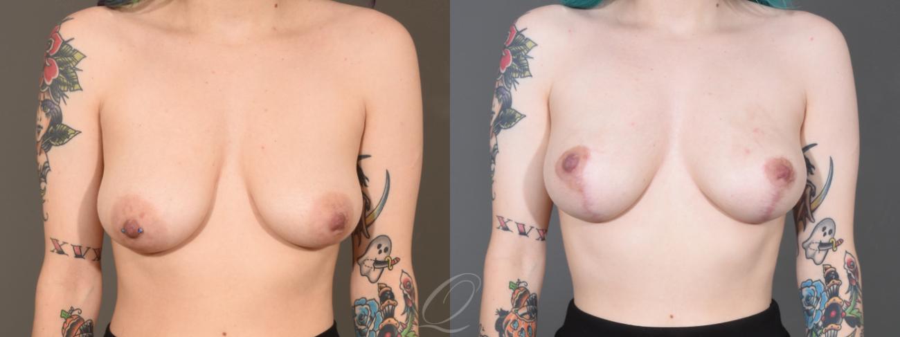Breast Augmentation with Fat Transfer Case 1358 Before & After Front | Serving Rochester, Syracuse & Buffalo, NY | Quatela Center for Plastic Surgery