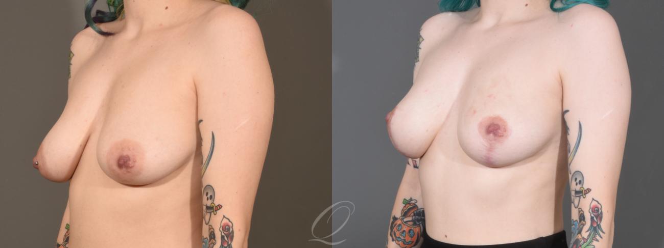 Breast Augmentation with Fat Transfer Case 1358 Before & After Left Oblique | Serving Rochester, Syracuse & Buffalo, NY | Quatela Center for Plastic Surgery
