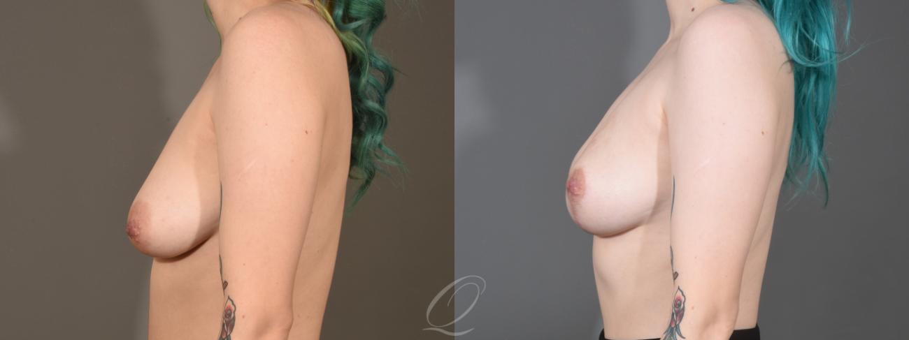 Breast Augmentation with Fat Transfer Case 1358 Before & After Left Side | Serving Rochester, Syracuse & Buffalo, NY | Quatela Center for Plastic Surgery