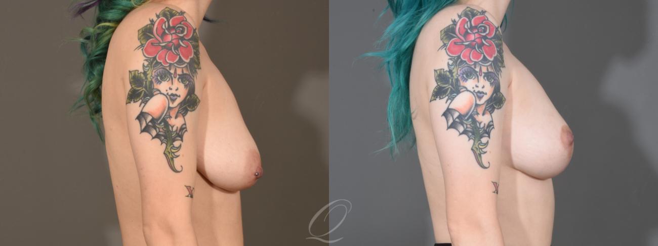 Breast Augmentation with Fat Transfer Case 1358 Before & After Right Side | Serving Rochester, Syracuse & Buffalo, NY | Quatela Center for Plastic Surgery
