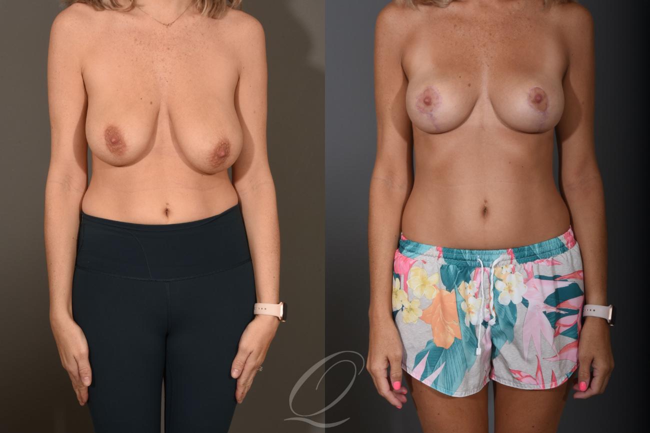 Breast Lift Case 1400 Before & After Front | Serving Rochester, Syracuse & Buffalo, NY | Quatela Center for Plastic Surgery