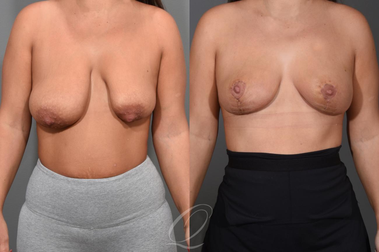 Breast Lift Case 1475 Before & After Front | Serving Rochester, Syracuse & Buffalo, NY | Quatela Center for Plastic Surgery
