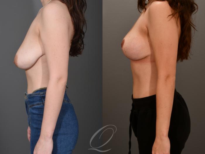 Breast Lift Case 1001555 Before & After Left Side | Serving Rochester, Syracuse & Buffalo, NY | Quatela Center for Plastic Surgery