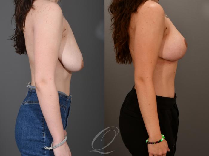 Breast Lift Case 1001555 Before & After Right Side | Serving Rochester, Syracuse & Buffalo, NY | Quatela Center for Plastic Surgery