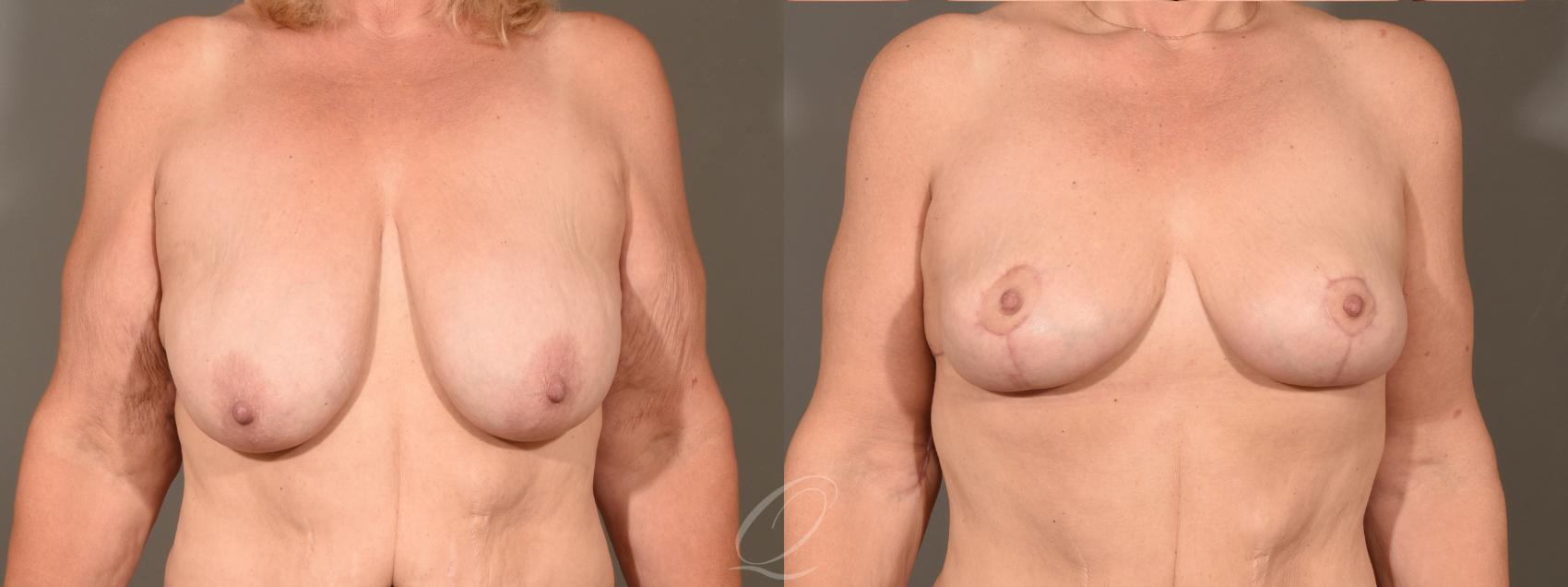 Breast Lift Case 1001567 Before & After Front | Serving Rochester, Syracuse & Buffalo, NY | Quatela Center for Plastic Surgery