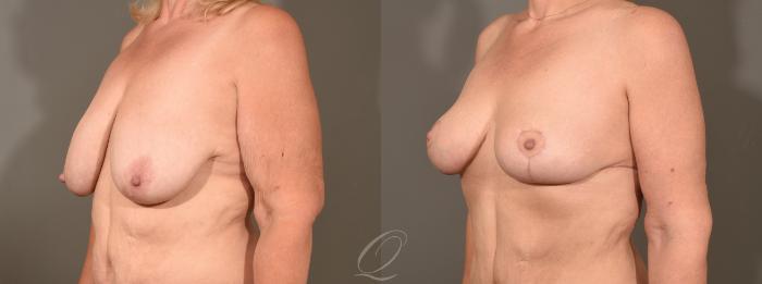 Breast Lift Case 1001567 Before & After Left Oblique | Serving Rochester, Syracuse & Buffalo, NY | Quatela Center for Plastic Surgery