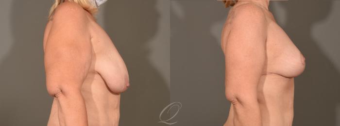 Breast Lift Case 1001567 Before & After Right Side | Serving Rochester, Syracuse & Buffalo, NY | Quatela Center for Plastic Surgery