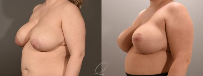 Breast Lift Case 1001600 Before & After Left Oblique | Serving Rochester, Syracuse & Buffalo, NY | Quatela Center for Plastic Surgery