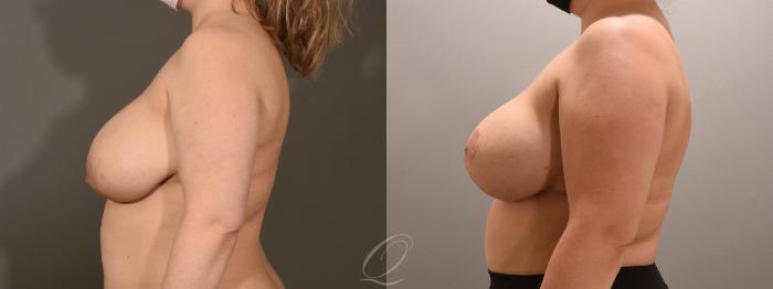 Breast Lift Case 1001600 Before & After Left Side | Serving Rochester, Syracuse & Buffalo, NY | Quatela Center for Plastic Surgery