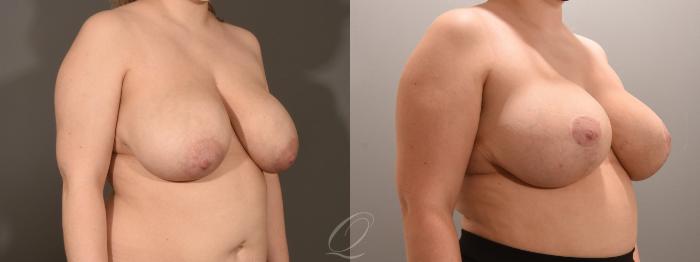 Breast Lift Case 1001600 Before & After Right Oblique | Serving Rochester, Syracuse & Buffalo, NY | Quatela Center for Plastic Surgery