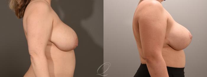 Breast Lift Case 1001600 Before & After Right Side | Serving Rochester, Syracuse & Buffalo, NY | Quatela Center for Plastic Surgery