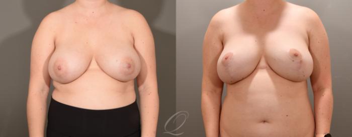 Breast Lift Case 1001601 Before & After Front | Serving Rochester, Syracuse & Buffalo, NY | Quatela Center for Plastic Surgery