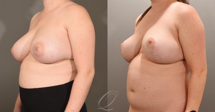 Breast Lift Case 1001601 Before & After Left Oblique | Serving Rochester, Syracuse & Buffalo, NY | Quatela Center for Plastic Surgery