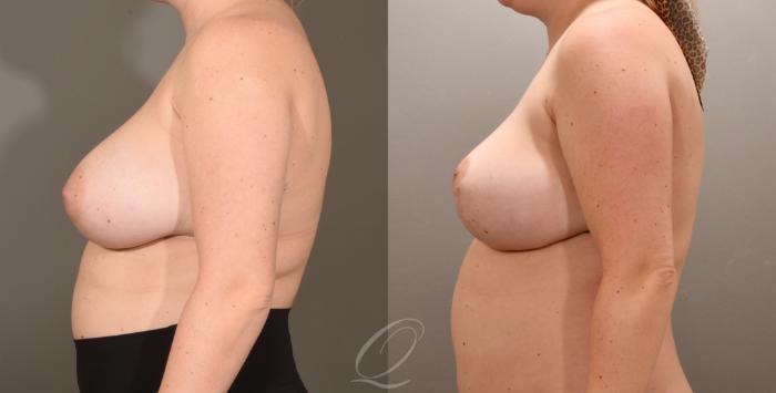 Breast Lift Case 1001601 Before & After Left Side | Serving Rochester, Syracuse & Buffalo, NY | Quatela Center for Plastic Surgery