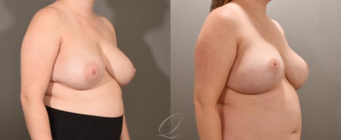 Breast Lift Case 1001601 Before & After Right Oblique | Serving Rochester, Syracuse & Buffalo, NY | Quatela Center for Plastic Surgery