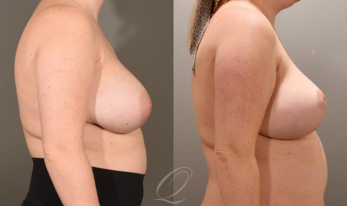 Breast Lift Case 1001601 Before & After Right Side | Serving Rochester, Syracuse & Buffalo, NY | Quatela Center for Plastic Surgery