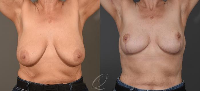 Breast Lift Case 1001602 Before & After Front | Serving Rochester, Syracuse & Buffalo, NY | Quatela Center for Plastic Surgery