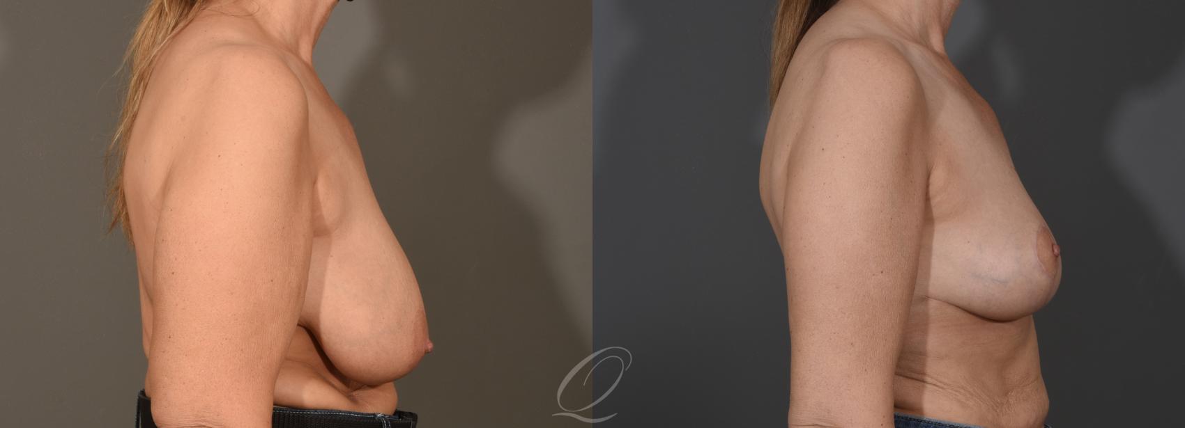 Breast Lift Case 1001602 Before & After Right Side | Serving Rochester, Syracuse & Buffalo, NY | Quatela Center for Plastic Surgery