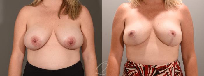 Breast Lift Case 1001603 Before & After Front | Serving Rochester, Syracuse & Buffalo, NY | Quatela Center for Plastic Surgery