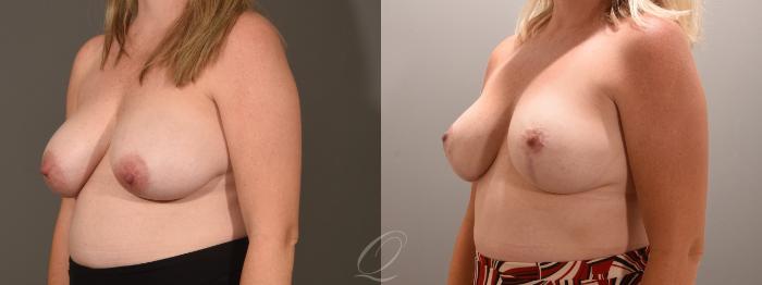 Breast Lift Case 1001603 Before & After Left Oblique | Serving Rochester, Syracuse & Buffalo, NY | Quatela Center for Plastic Surgery