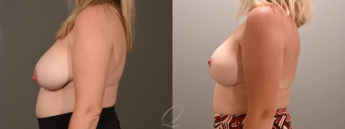 Breast Lift Case 1001603 Before & After Left Side | Serving Rochester, Syracuse & Buffalo, NY | Quatela Center for Plastic Surgery