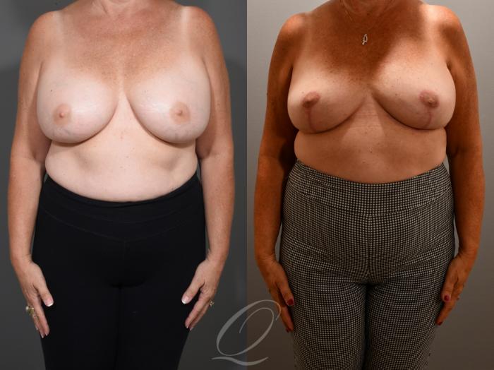 Breast Augmentation Revision Case 1001623 Before & After Front | Serving Rochester, Syracuse & Buffalo, NY | Quatela Center for Plastic Surgery