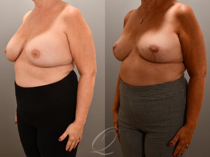 Breast Augmentation Revision Case 1001623 Before & After Left Oblique | Serving Rochester, Syracuse & Buffalo, NY | Quatela Center for Plastic Surgery