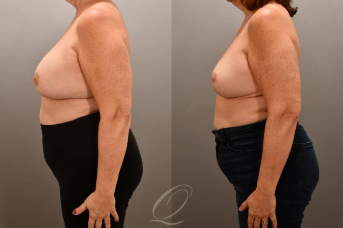 Breast Augmentation with Fat Transfer Case 1001623 Before & After Left Side | Serving Rochester, Syracuse & Buffalo, NY | Quatela Center for Plastic Surgery