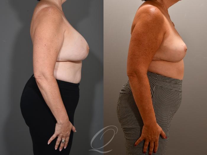 Breast Augmentation Revision Case 1001623 Before & After Right Side | Serving Rochester, Syracuse & Buffalo, NY | Quatela Center for Plastic Surgery