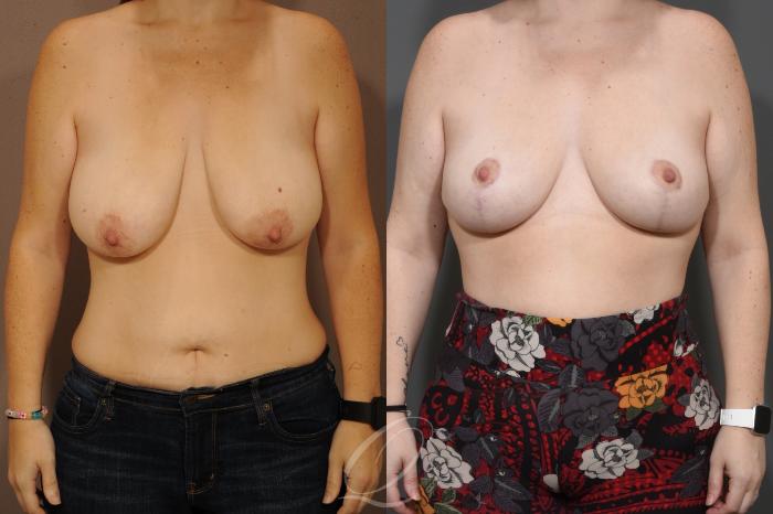 Breast Lift Case 1001627 Before & After Front | Serving Rochester, Syracuse & Buffalo, NY | Quatela Center for Plastic Surgery
