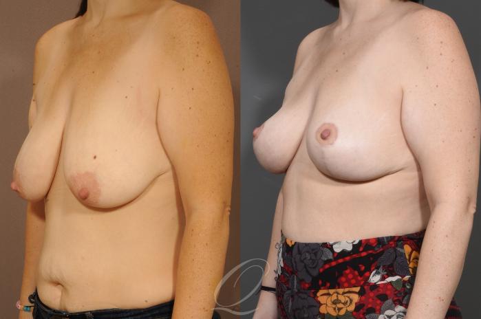 Breast Lift Case 1001627 Before & After Left Oblique | Serving Rochester, Syracuse & Buffalo, NY | Quatela Center for Plastic Surgery