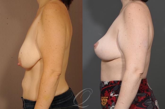 Breast Lift Case 1001627 Before & After Left Side | Serving Rochester, Syracuse & Buffalo, NY | Quatela Center for Plastic Surgery
