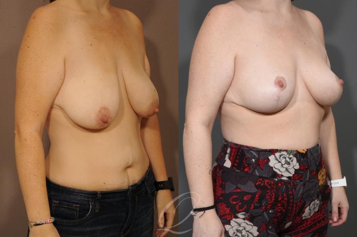Breast Lift Case 1001627 Before & After Right Oblique | Serving Rochester, Syracuse & Buffalo, NY | Quatela Center for Plastic Surgery