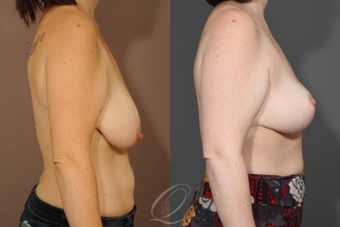Breast Lift Case 1001627 Before & After Right Side | Serving Rochester, Syracuse & Buffalo, NY | Quatela Center for Plastic Surgery