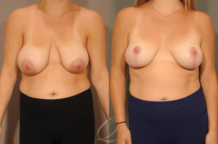 Breast Lift Case 1001628 Before & After Front | Serving Rochester, Syracuse & Buffalo, NY | Quatela Center for Plastic Surgery