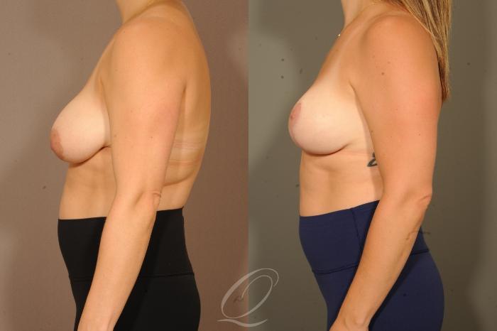 Breast Lift Case 1001628 Before & After Left Side | Serving Rochester, Syracuse & Buffalo, NY | Quatela Center for Plastic Surgery