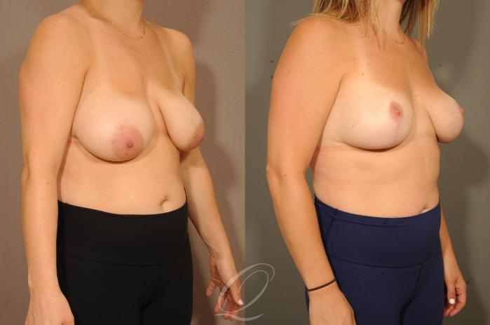 Breast Lift Case 1001628 Before & After Right Oblique | Serving Rochester, Syracuse & Buffalo, NY | Quatela Center for Plastic Surgery