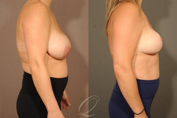 Breast Lift Case 1001628 Before & After Right Side | Serving Rochester, Syracuse & Buffalo, NY | Quatela Center for Plastic Surgery