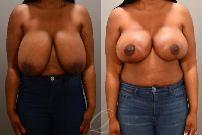 Breast Lift Case 1001630 Before & After Front | Serving Rochester, Syracuse & Buffalo, NY | Quatela Center for Plastic Surgery